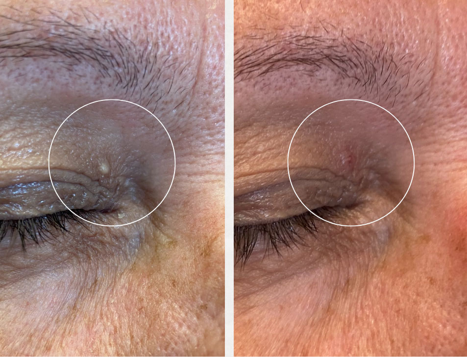 Photos of before and after cyst removal by Dr. Rice