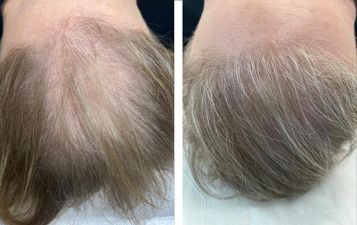 A photo of before and after exosome treatment on a female scalp.