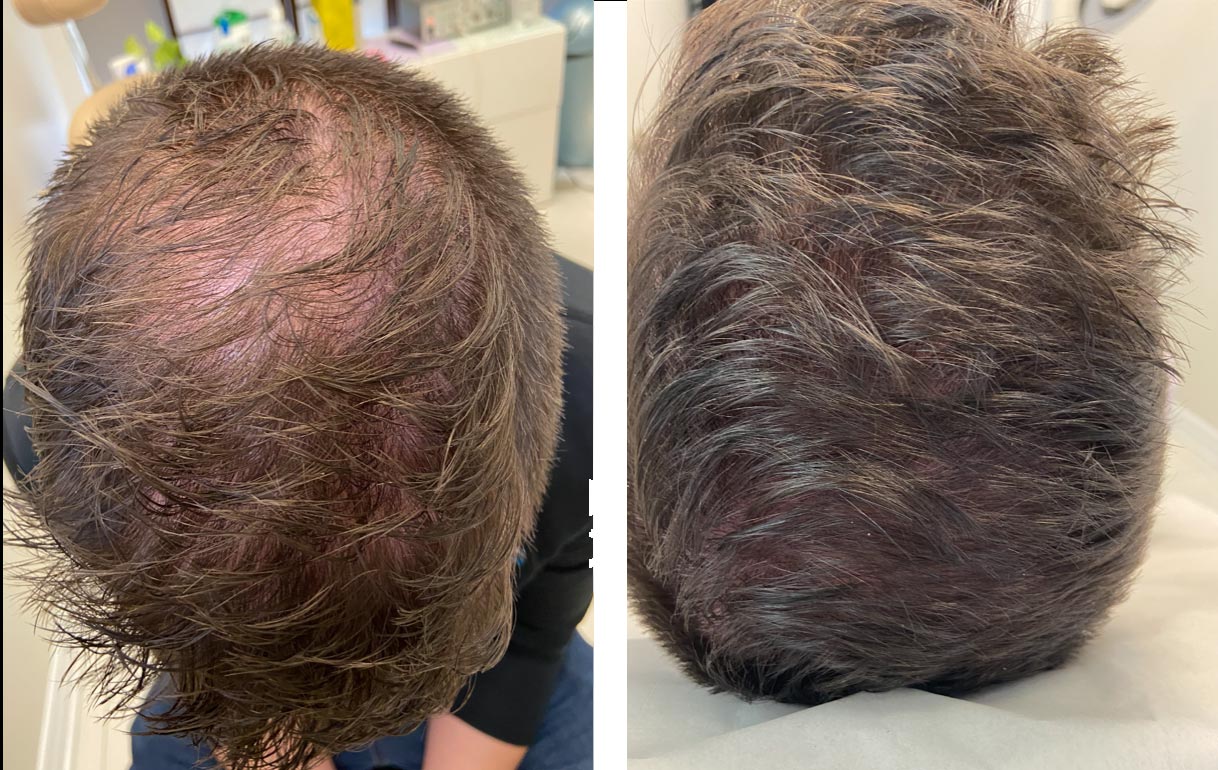 A photo of before and after exosome treatment on a male scalp.