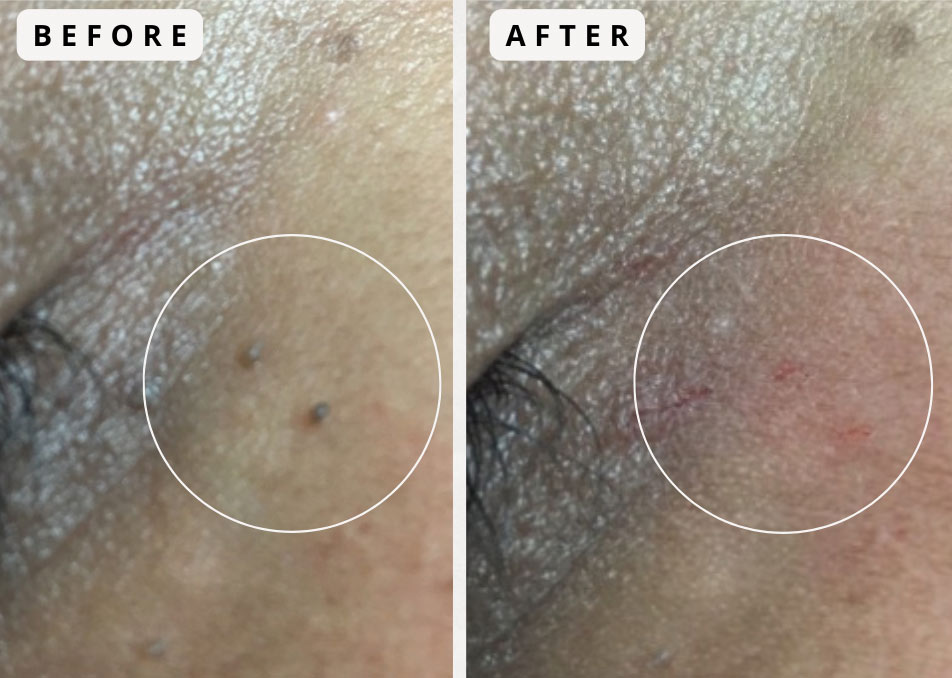 Photos of before and after a skin lesion removal by Dr. Rice