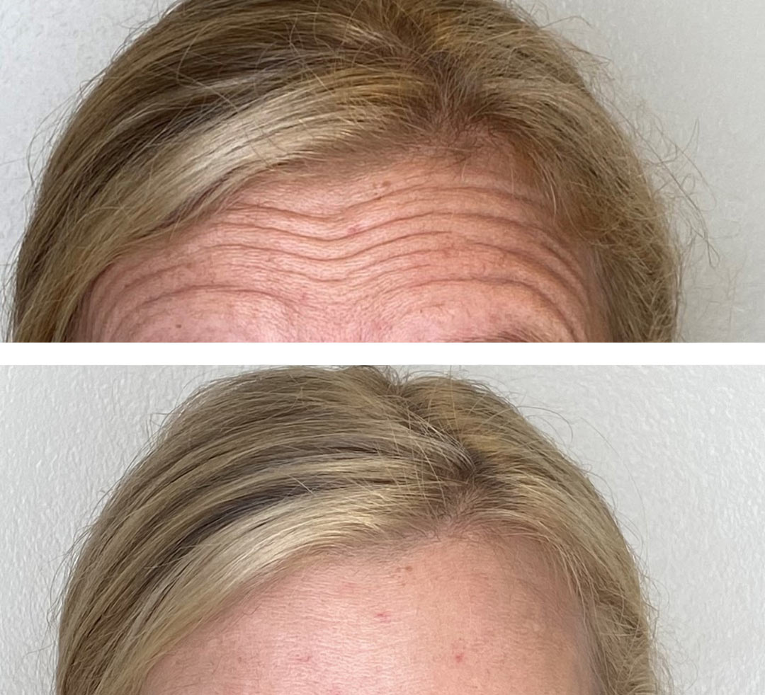 A photo of a forehead prior to and after botox injections.