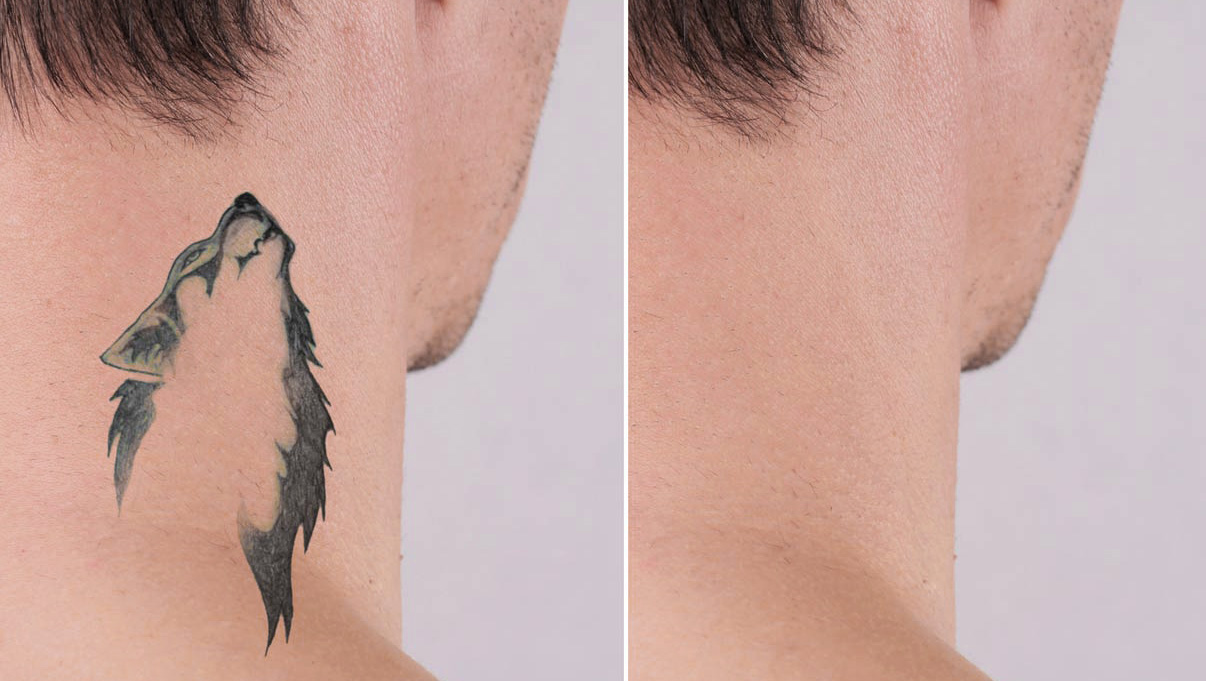 A photo of before and after tattoo removal.